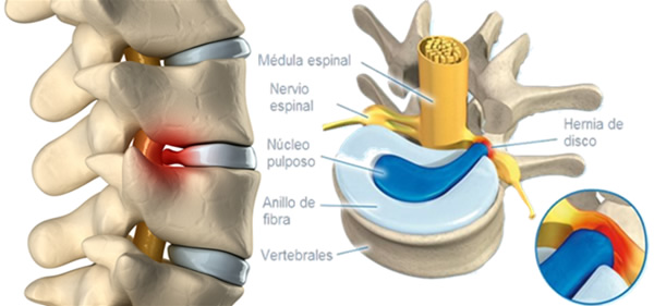 Cirugía disco vertebral lumbar