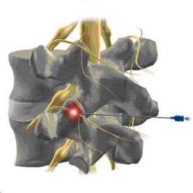 Tratamiento percutáneo del dolor lumbar